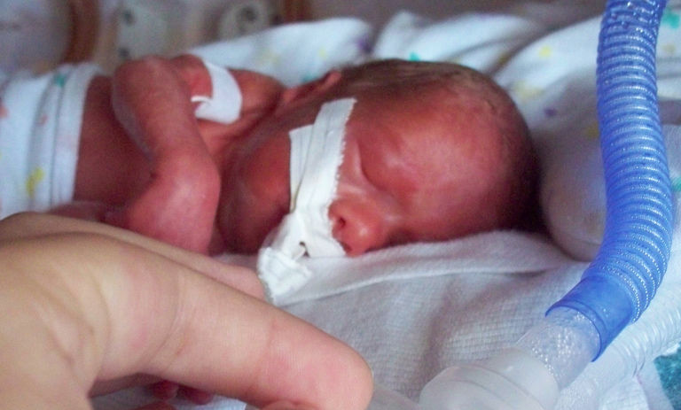A 2009 image of an intubated female infant born prematurely, at 26 weeks and six days gestation, and weighing 990 grams 2.1 pounds. Photo taken at approximately 24 hours after birth.